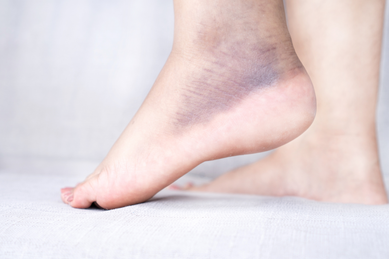 Foot with purplish discoloration.