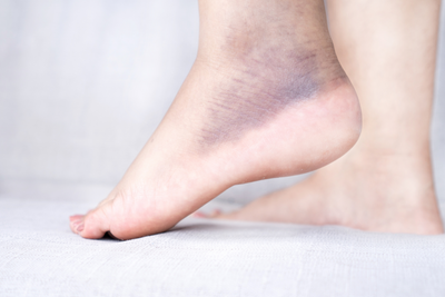 Will Gout Cause Bruising? | Understanding the Symptoms and Effects