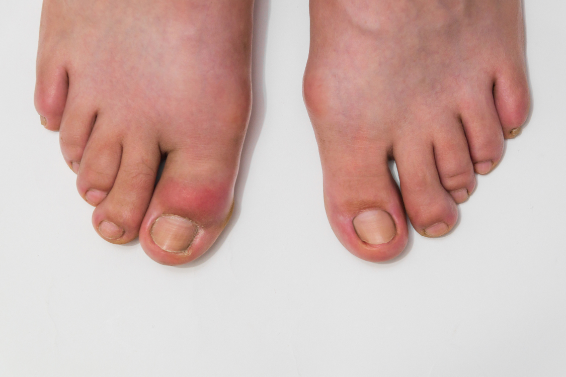 3D image showing the difference between acute gout and chronic gout in the feet