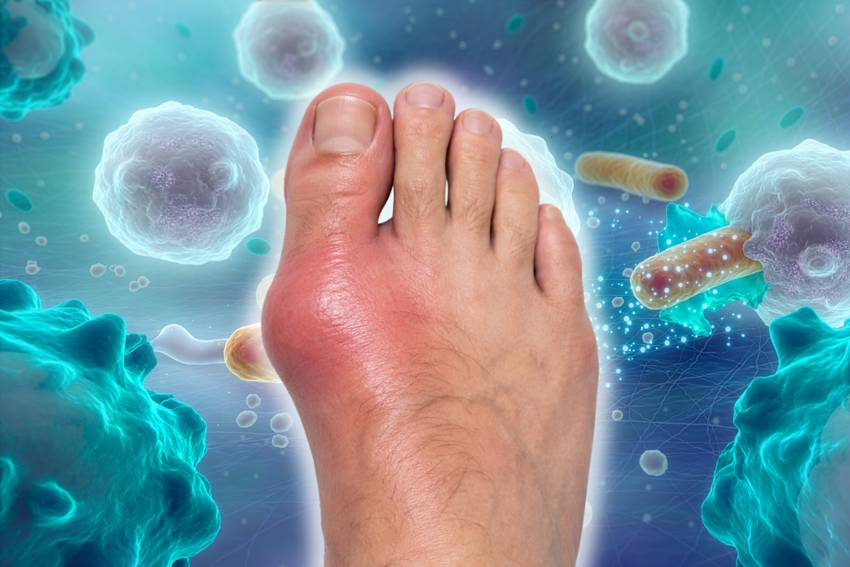 Swollen red big toe during a gout flare with immune cells, illustrating gout-related inflammation and immune response.