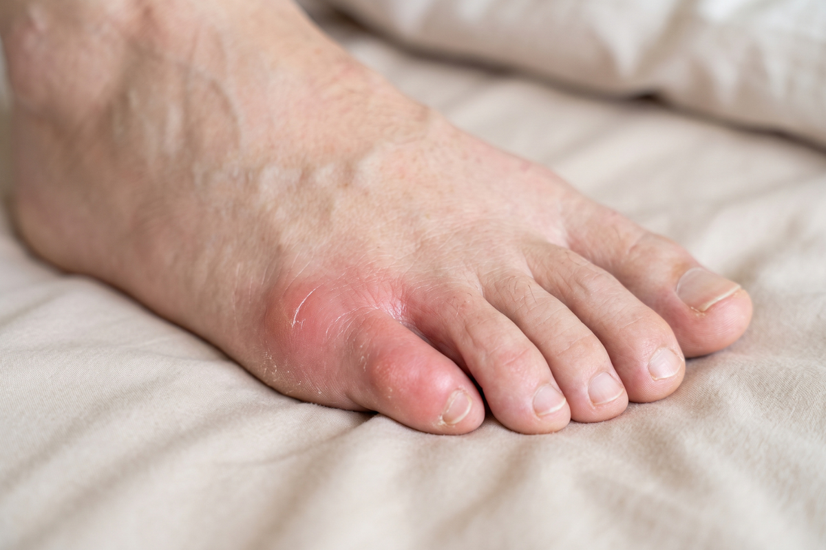 Red, swollen little toe and outer foot showing signs of a possible gout flare.