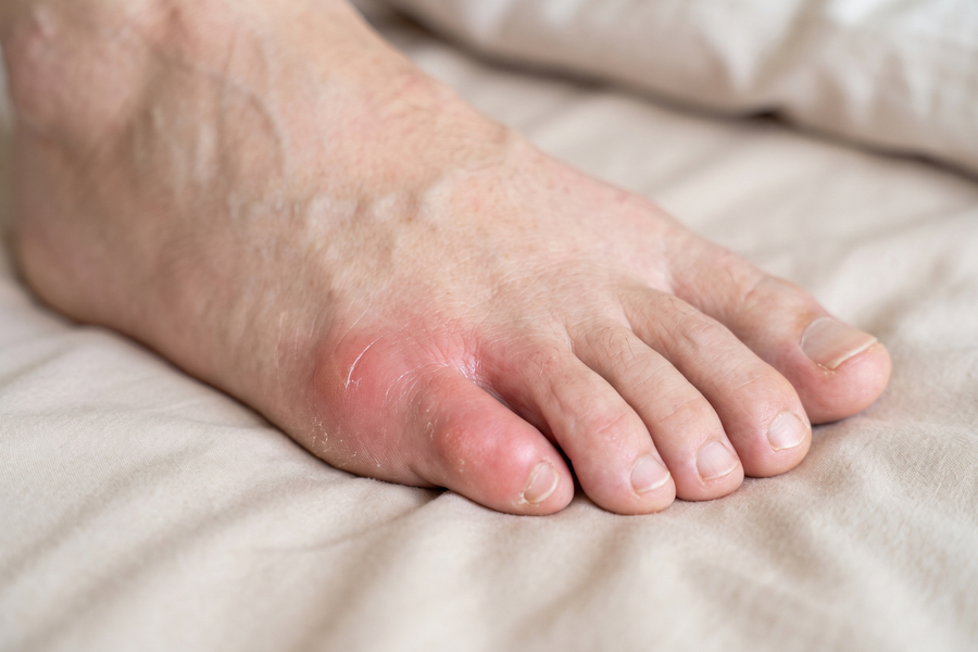 Red, swollen little toe and outer foot showing signs of a possible gout flare.