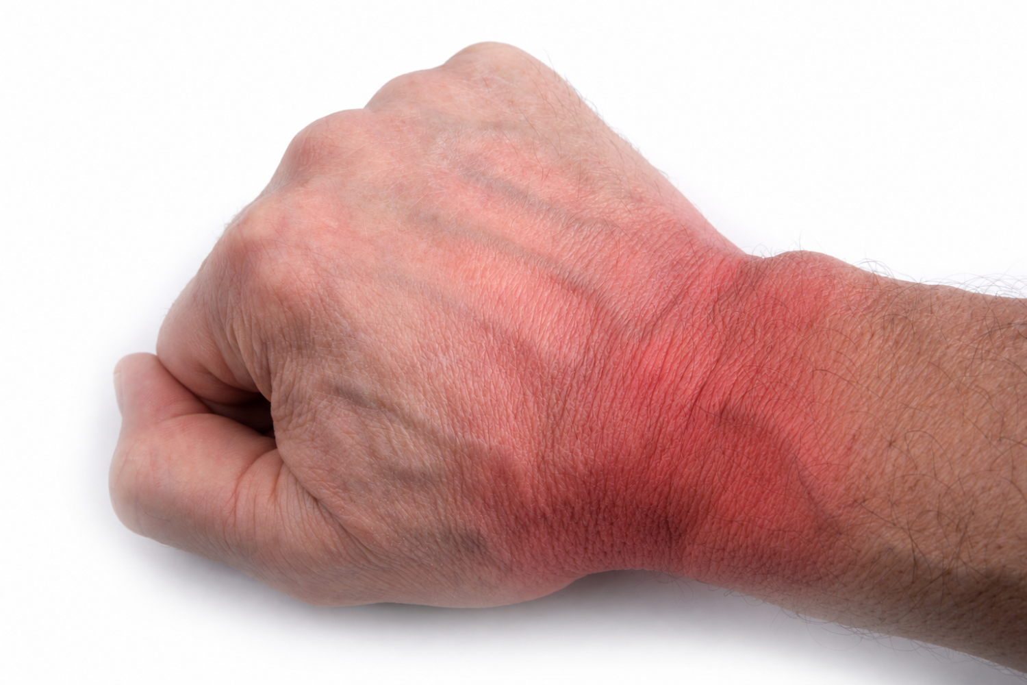 Inflamed gout wrist close-up