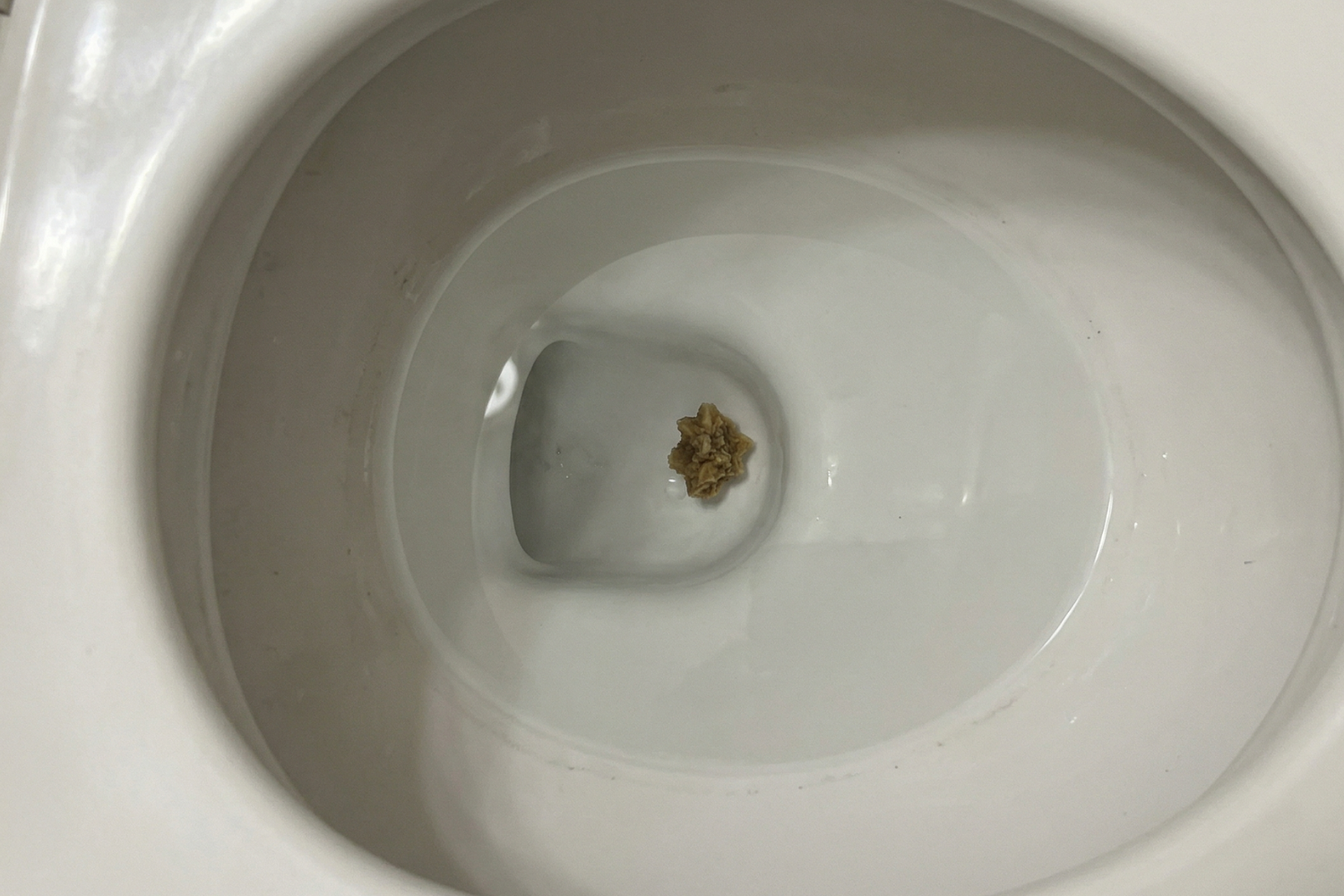 Photo of a kidney stone in the toilet bowl, showing how a passed stone fragment may appear after urination in women.