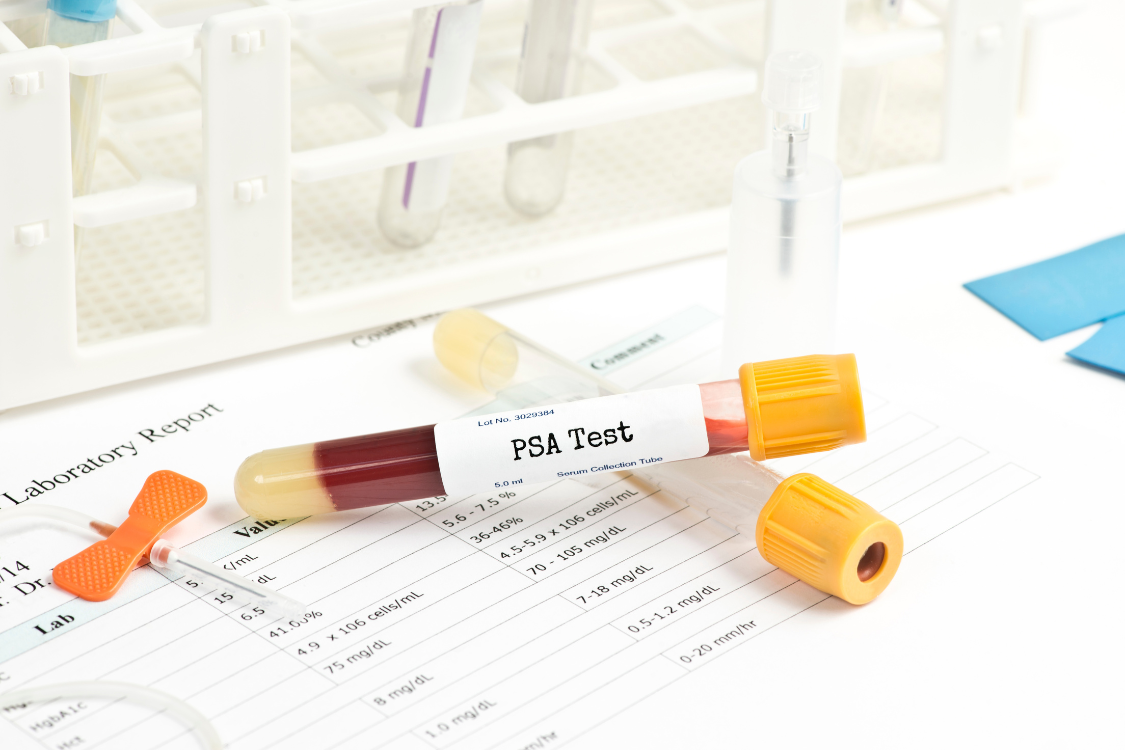 Blood sample labeled PSA test used to calculate the Prostate Health Index (PHI) for prostate cancer detection