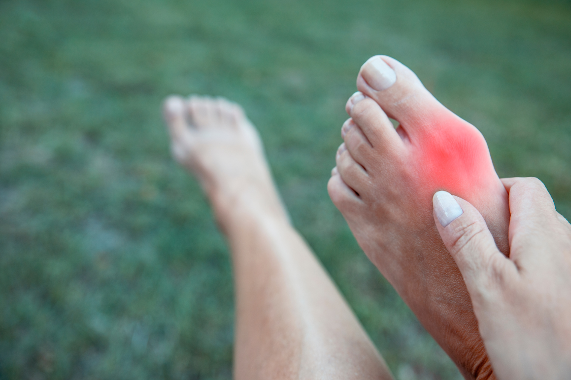 Person holding foot with red, inflamed bunion indicating a flare-up