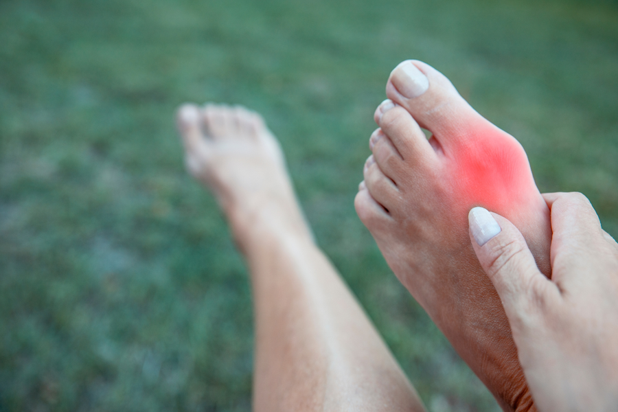 Person holding foot with red, inflamed bunion indicating a flare-up