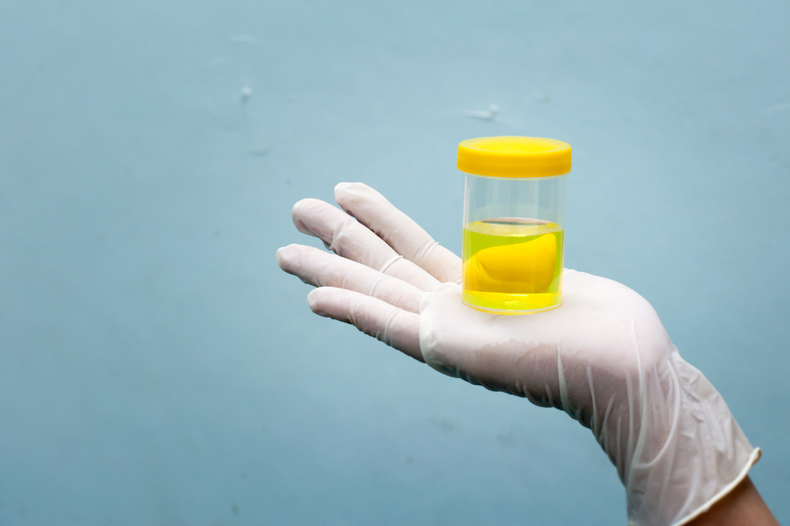 Gloved hand holding a urine sample container for urinary health testing