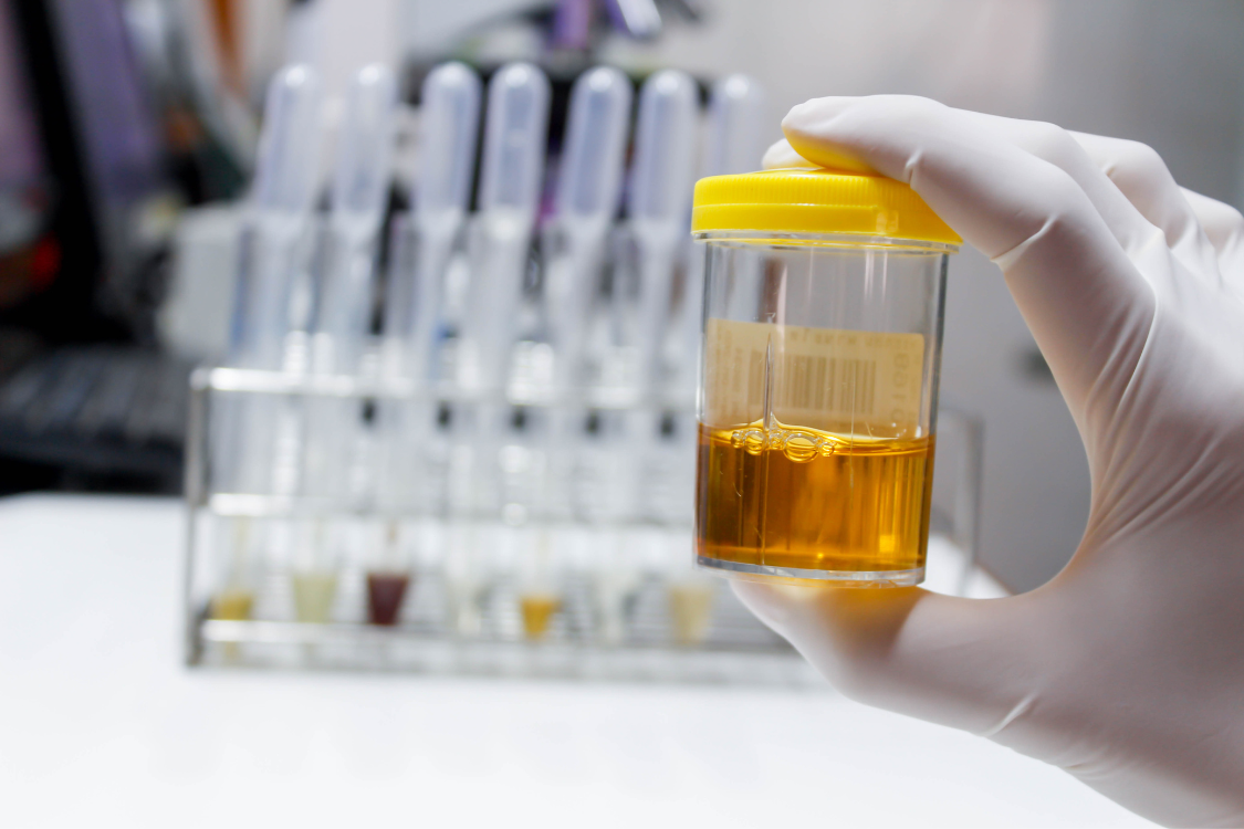 Urine sample in lab used to monitor urinary symptoms and prostate health