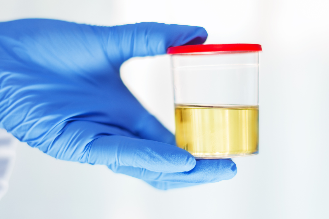 Close-up of a urine sample in a lab container used to check bladder health and urinary function