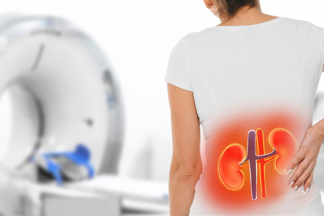 Illustration of kidney inflammation in a woman, highlighting the impact of high uric acid and gout on kidney health