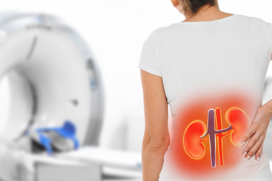 Illustration of kidney inflammation in a woman, highlighting the impact of high uric acid and gout on kidney health